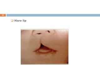  Hare lip
32
 