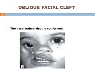 OBLIQUE FACIAL CLEFT
 The nasolacrimal duct is not formed.
33
 
