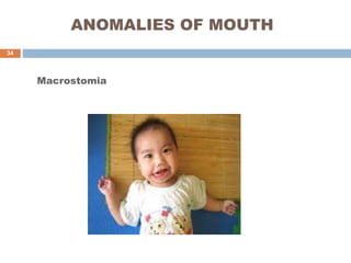 ANOMALIES OF MOUTH
Macrostomia
34
 