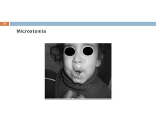 Microstomia
35
 