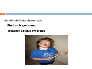 Mandibulofacial dysostosis
 First arch syndrome
 Treacher Collin’s syndrome
36
 