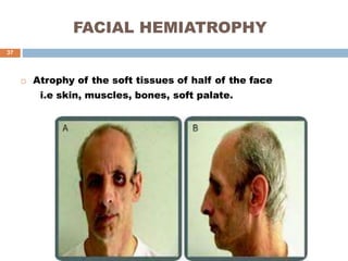 FACIAL HEMIATROPHY
 Atrophy of the soft tissues of half of the face
i.e skin, muscles, bones, soft palate.
37
 