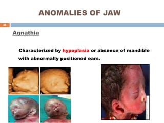 ANOMALIES OF JAW
Agnathia
Characterized by hypoplasia or absence of mandible
with abnormally positioned ears.
38
 