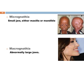  Micrognathia
Small jaw, either maxilla or mandible
 Macrognathia
Abnormally large jaws.
39
 
