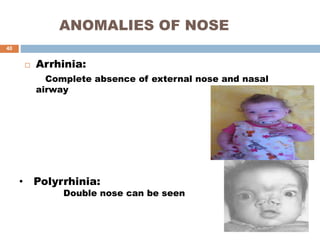 ANOMALIES OF NOSE
 Arrhinia:
Complete absence of external nose and nasal
airway
• Polyrrhinia:
Double nose can be seen
40
 