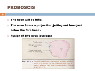PROBOSCIS
 The nose will be bifid.
 The nose forms a projection ,jutting out from just
below the fore head .
 Fusion of two eyes (cyclops)
41
 