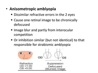 • Anisometropic amblyopia
 Dissimilar refractive errors in the 2 eyes
 Cause one retinal image to be chronically
defocused
 Image blur and partly from interocular
competition
 Or inhibition similar (but not identical) to that
responsible for strabismic amblyopia
 