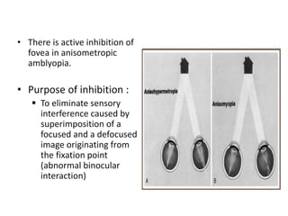 • There is active inhibition of
fovea in anisometropic
amblyopia.
• Purpose of inhibition :
 To eliminate sensory
interference caused by
superimposition of a
focused and a defocused
image originating from
the fixation point
(abnormal binocular
interaction)
 