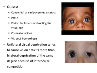 • Causes:
 Congenital or early-acquired cataract
 Ptosis
 Periocular lesions obstructing the
visual axis
 Corneal opacities
 Vitreous hemorrhage
• Unilateral visual deprivation tends
to cause vision deficits more than
bilateral deprivation of the same
degree because of interocular
competition
 