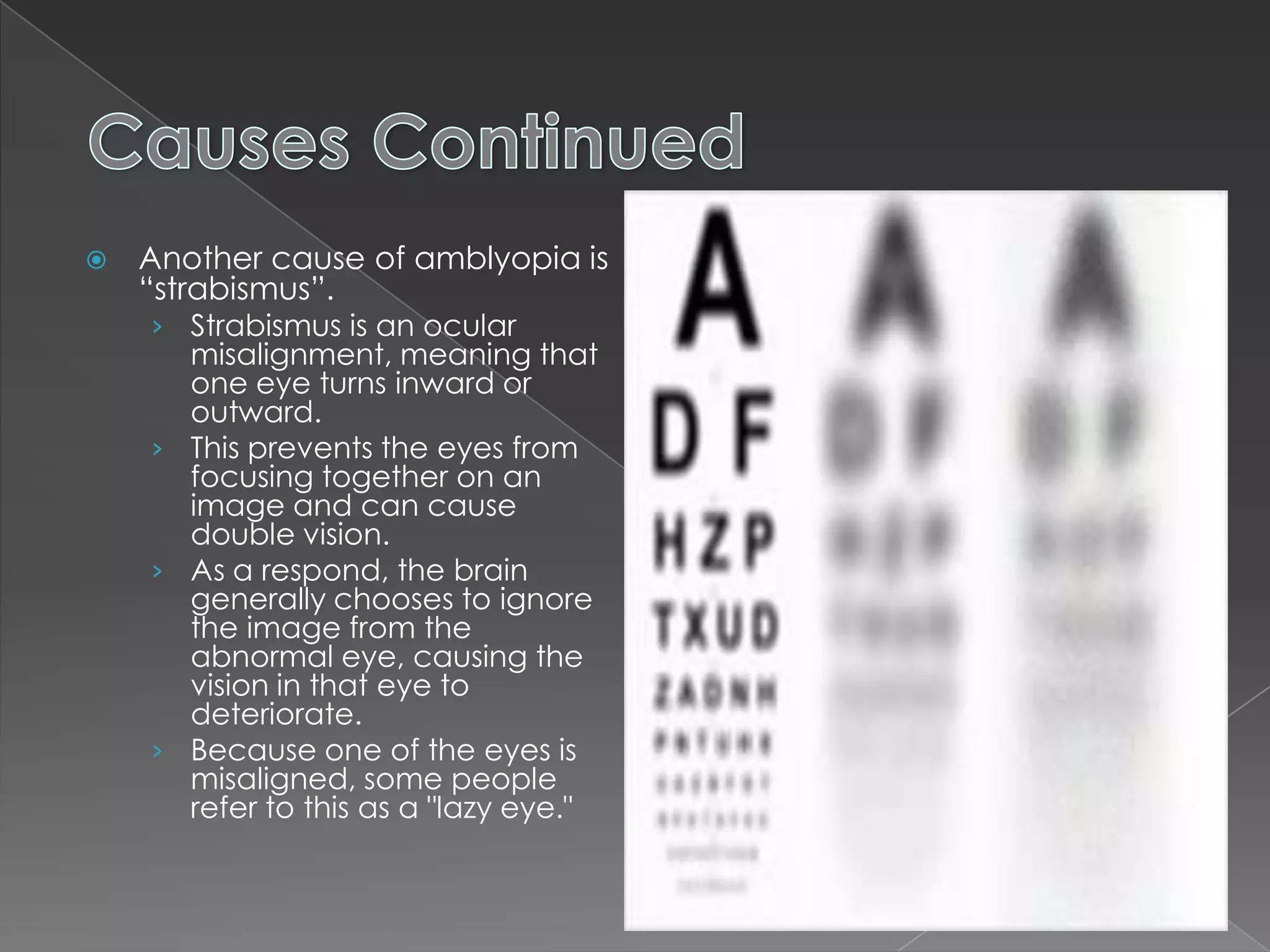    Another cause of amblyopia is
    “strabismus”.
    › Strabismus is an ocular
      misalignment, meaning that
      one eye turns inward or
      outward.
    › This prevents the eyes from
      focusing together on an
      image and can cause
      double vision.
    › As a respond, the brain
      generally chooses to ignore
      the image from the
      abnormal eye, causing the
      vision in that eye to
      deteriorate.
    › Because one of the eyes is
      misaligned, some people
      refer to this as a "lazy eye."
 