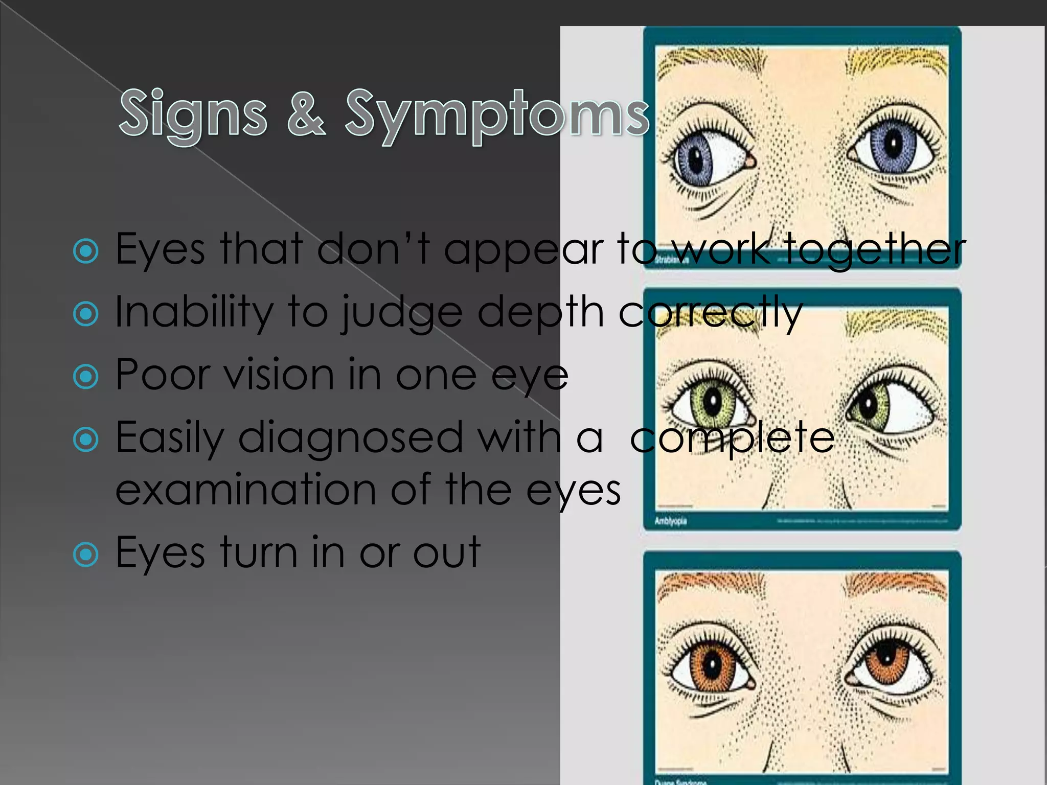  Eyes that don’t appear to work together
 Inability to judge depth correctly
 Poor vision in one eye
 Easily diagnosed with a complete
  examination of the eyes
 Eyes turn in or out
 