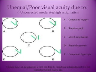 Introduction, Assessment and Management of Amblyopia | PPT