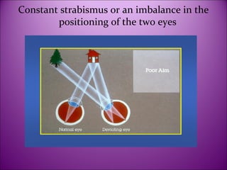 Introduction, Assessment and Management of Amblyopia | PPT