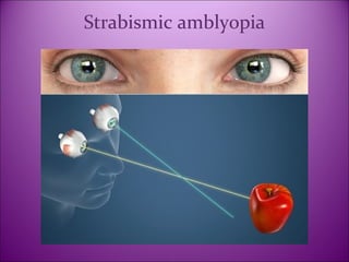 Introduction, Assessment and Management of Amblyopia | PPT