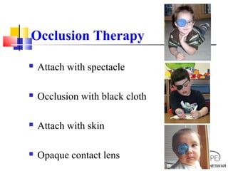 BHUBANESWAR
Occlusion Therapy
BHUBANESWAR
 Attach with spectacle
 Occlusion with black cloth
 Attach with skin
 Opaque contact lens
 