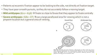 • Patients w/ eccentric fixation appear to be looking to the side, not directly at fixation target.
• They have poor smooth pursuits, so they do not accurately follow a moving target.
• Mild amblyopes (6/12– 6/36)  fixate so close to fovea that they appear to fixate centrally
• Severe amblyopes ( 6/60 –CF) use a large parafoveal area for viewing which is not a
pinpoint location but a general area of viewing.
31
 