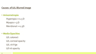 Causes of U/L Blurred image
• Anisometropia
Hyperopia >+1.5 D
Myopia >-3 D
Meridional >+1.5D
• Media Opacities
U/L cataract
U/L corneal opacity
U/L vit h’ge
U/l vit opacity
37
 