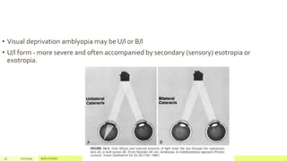 • Visual deprivation amblyopia may be U/l or B/l
• U/l form - more severe and often accompanied by secondary (sensory) esotropia or
exotropia.
52 2/2/2019 Add a footer
 