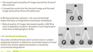 • Decreased optical quality of image received by fovea of
deprived eye
• Competition exists b/w this blurred image and focused
image received by fovea of healthy eye.
In B/l equal density cataracts , b/l uncorrected high
hypermetropia or astigmatism (ametropic amblyopia) ,
• Optical quality of images decreased equally in BEno
such competitive situation  pattern vision deprivation
is the only amblyopiogenic factor
• In meridional amblyopia,
Accurate cylindrical lenses dont correct vision in certain
astigmatic patients as Selective visual deprivation of visual
stimuli of a certain spatial orientation is caused by
uncorrected astigmatism
53 2/2/2019 Add a footer
 