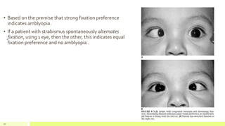 • Based on the premise that strong fixation preference
indicates amblyopia.
• If a patient with strabismus spontaneously alternates
fixation, using 1 eye, then the other, this indicates equal
fixation preference and no amblyopia .
70
 