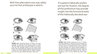 With free alternation one may safely
assume that amblyopia is absent.
74 2/2/2019 Add a footer
If a patient habitually prefers
one eye for fixation, the degree
of this preference may provide
insight into the functional state
of the habitually deviated eye
 