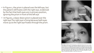 • In Figure 1, the prism is placed over the left eye, but
the patient still fixates with the right eye, evidenced
by the fact that both eyes are in primary position,
ignoring the prism in front of the left eye
• In Figure2, a base-down prism is placed over the
right eye.The right eye is fixing because both eyes
move up as the right eye fixates through the prism.
79
 