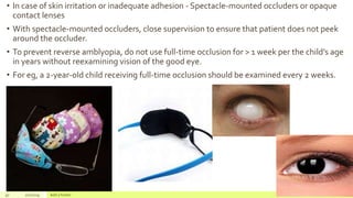 • In case of skin irritation or inadequate adhesion - Spectacle-mounted occluders or opaque
contact lenses
• With spectacle-mounted occluders, close supervision to ensure that patient does not peek
around the occluder.
• To prevent reverse amblyopia, do not use full-time occlusion for > 1 week per the child’s age
in years without reexamining vision of the good eye.
• For eg, a 2-year-old child receiving full-time occlusion should be examined every 2 weeks.
97 2/2/2019 Add a footer
 