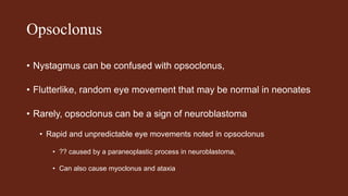 Opsoclonus
• Nystagmus can be confused with opsoclonus,
• Flutterlike, random eye movement that may be normal in neonates
• Rarely, opsoclonus can be a sign of neuroblastoma
• Rapid and unpredictable eye movements noted in opsoclonus
• ?? caused by a paraneoplastic process in neuroblastoma,
• Can also cause myoclonus and ataxia
 