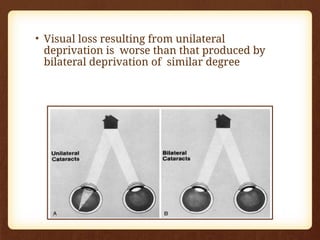 • Visual loss resulting from unilateral
deprivation is worse than that produced by
bilateral deprivation of similar degree
 