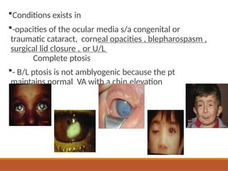 Conditions exists in
-opacities of the ocular media s/a congenital or
traumatic cataract, corneal opacities , blepharospasm ,
surgical lid closure , or U/L
Complete ptosis
- B/L ptosis is not amblyogenic because the pt
maintains normal VA with a chin elevation
 