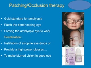 Amblyopia adio 2020 | PPT