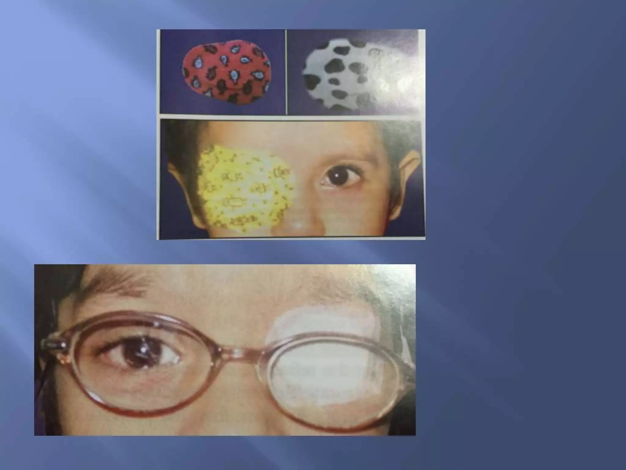 Amblyopia | PPTX