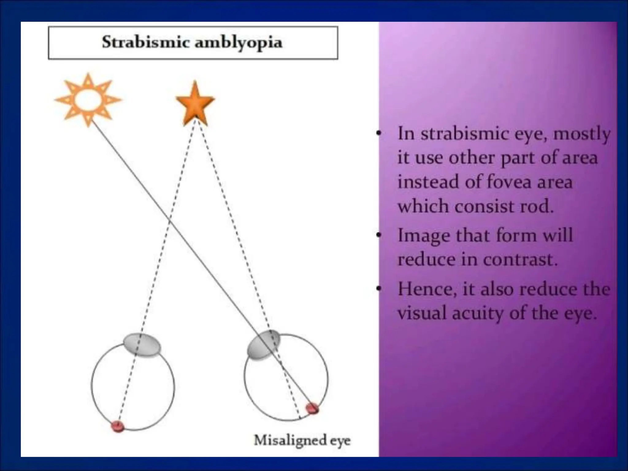 AMBLYOPIA CLASSIFICATION-SQUINT.ppt classification of ambylopia ppt | PPT