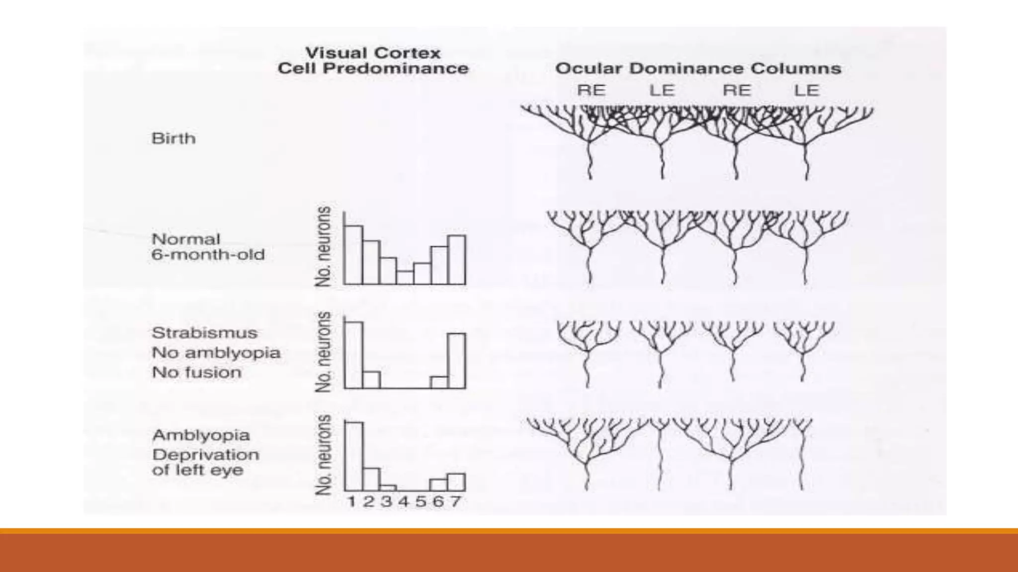 Amblyopia : classification & Occlusion therapy | PPTX