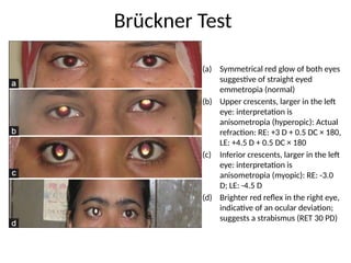 (a) Symmetrical red glow of both eyes
suggestive of straight eyed
emmetropia (normal)
(b) Upper crescents, larger in the left
eye: interpretation is
anisometropia (hyperopic): Actual
refraction: RE: +3 D + 0.5 DC × 180,
LE: +4.5 D + 0.5 DC × 180
(c) Inferior crescents, larger in the left
eye: interpretation is
anisometropia (myopic): RE: -3.0
D; LE: -4.5 D
(d) Brighter red reflex in the right eye,
indicative of an ocular deviation;
suggests a strabismus (RET 30 PD)
Brückner Test
 