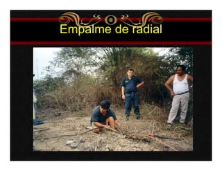 Empalme de radial 
 