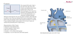 P wave
The sinoatrial (SA) node is high in
the wall of the right atrium and
initiates atrial depolarisation which
produces the P wave on the
electrocardiogram.The P wave thus
represents atrial depolarisation and
not SA node depolarisation, as is
sometimes mistakenly believed.
Although anatomically the atria are two distinct chambers, electrically they
act almost as one.They have relatively little muscle and generate a single,
small P wave.The duration of the P wave should not exceed 0.12 seconds.
P wave amplitude (height) rarely exceeds 0.25 mV. Sinus P waves are
usually most prominently seen in leads II and V1
.
Characteristics of the P wave
•	 Represents atrial depolarisation
•	 Positive (upright) in leads I and II
•	 Best seen in leads II and V1
•	 Duration < 0.12 s (three small squares)
•	 Amplitude < 0.25 mV (two and a half small squares)
P wave
Sinoatrial node
Atrioventricular
node
Right atrium
Wave of
depolarisation
Left atrium
Atrial depolarisation gives rise to the P wave.
 