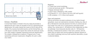 Diagnosis
•	 P waves have normal morphology
•	 Atrial and ventricular rate 60 – 100 beats/min
•	 Regular ventricular rhythm
•	 Every P wave is followed by a QRS complex
•	 PR interval 0.12 – 0.22 s (three to five and a half small squares)
•	 QRS complexes < 0.12 s (three small squares)
Signs and symptoms
Exercise and emotion are potent accelerators of sinus rhythm through
sympathetic, neural and catecholamine stimulation. Resting sinus rates of
60 to 100 beats/min classically represents the limits of a normal rate, but
much slower sinus rates occur in young persons, particularly trained
athletes.Thus, resting rates of < 60 beats/min (sinus bradycardia) are often
not pathologic. Sinus tachycardia describes rates of > 100 beats/min.
Normally, a marked diurnal variation in heart rate is common, with the
lowest rates just before early morning awakening.Absolute regularity of
sinus rhythm is pathologic and occurs with autonomic denervation, as seen
in advanced diabetes.
Sinus rhythm
A normal heart rhythm is initiated in the sinus node and proceeds to
depolarise the atria. P wave are recorded on the ECG, representing atrial
depolarisation.The cardiac impulse then travels to the AV node and the
bundle of His, traverses the bundle branches and the Purkinje fibres, and
a PR interval is recorded.The impulse then reaches the ventricular muscle,
and a QRS complex is displayed, representing ventricular depolarisation.
This complex is followed by an isoelectric ST segment and a T wave
representing ventricular re-polarisation.Altogether, this cycle is called
sinus rhythm.
Normal sinus rhythm.
 