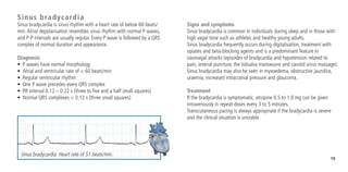 19
Signs and symptoms
Sinus bradycardia is common in individuals during sleep and in those with
high vagal tone such as athletes and healthy young adults.
Sinus bradycardia frequently occurs during digitalisation, treatment with
opiates and beta-blocking agents and is a predominant feature in
vasovagal attacks (episodes of bradycardia and hypotension related to
pain, arterial puncture, the Valsalva manoeuvre and carotid sinus massage).
Sinus bradycardia may also be seen in myxoedema, obstructive jaundice,
uraemia, increased intracranial pressure and glaucoma.
Treatment
If the bradycardia is symptomatic, atropine 0.5 to 1.0 mg can be given
intravenously in repeat doses every 3 to 5 minutes.
Transcutaneous pacing is always appropriate if the bradycardia is severe
and the clinical situation is unstable.
Sinus bradycardia
Sinus bradycardia is sinus rhythm with a heart rate of below 60 beats/
min.Atrial depolarisation resembles sinus rhythm with normal P waves,
and P-P intervals are usually regular. Every P wave is followed by a QRS
complex of normal duration and appearance.
Diagnosis
•	 P waves have normal morphology
•	 Atrial and ventricular rate of < 60 beats/min
•	 Regular ventricular rhythm
•	 One P wave precedes every QRS complex
•	 PR interval 0.12 – 0.22 s (three to five and a half small squares)
•	 Normal QRS complexes < 0.12 s (three small squares)
Sinus bradycardia. Heart rate of 51 beats/min.
 