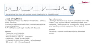 Sinus arrhythmia
Sinus arrhythmia, or irregular sinus rhythm, is characterised by a continuous
variation in heart rate.
The variation in cycle length is usually related to respiration and exhibits an
increase during expiration.
The PP and RR cycles usually vary for more than 0.16 of a second.
Diagnosis
•	 P waves have normal morphology
•	 Heart rate varies with respiration
•	 Atrial and ventricular rate of 60 – 100 beats/min
•	 Every P wave is followed by a QRS complex
•	 PR interval 0.12 – 0.22 s (three to five and a half small squares)
•	 QRS complex < 0.12 s (three small squares)
Signs and symptoms
Commonly in children and young adults, this is considered normal in the
context of a high vagal tone. The heart rate normally increases during
inspiration as a reflex response to an increased volume of blood returning
to the heart. Sinus arrhythmia is uncommon after the age of 40.
Treatment
The condition is completely harmless and no tests or treatment are
necessary.
Sinus arrhythmia. Sinus rhythm with continuous variation in the length of the PP (and RR) interval.
 