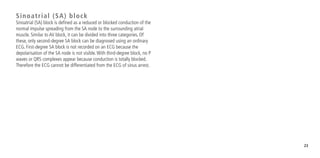 23
Sinoatrial (SA) block
Sinoatrial (SA) block is defined as a reduced or blocked conduction of the
normal impulse spreading from the SA node to the surrounding atrial
muscle. Similar to AV block, it can be divided into three categories. Of
these, only second-degree SA block can be diagnosed using an ordinary
ECG. First-degree SA block is not recorded on an ECG because the
depolarisation of the SA node is not visible.With third-degree block, no P
waves or QRS complexes appear because conduction is totally blocked.
Therefore the ECG cannot be differentiated from the ECG of sinus arrest.
 