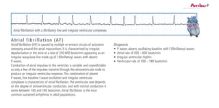 Diagnosis
•	 P waves absent; oscillating baseline with f (fibrillatory) waves
•	 Atrial rate of 350 – 600 beats/min
•	 Irregular ventricular rhythm
•	 Ventricular rate of 100 – 180 beats/min
Atrial fibrillation (AF)
Atrial fibrillation (AF) is caused by multiple re-entrant circuits of activation
sweeping around the atrial myocardium. It is characterised by irregular
depolarisation in the atria at a rate of 350-600 beats/min appearing as an
irregular wavy base line made up of f (fibrillatory) waves with absent
P waves.
Conduction of atrial impulses to the ventricles is variable and unpredictable
as only a few of the impulses transmit through the atrioventricular node to
produce an irregular ventricular response.This combination of absent
P waves, fine baseline f-wave oscillation and irregular ventricular
complexes is characteristic of atrial fibrillation.The ventricular rate depends
on the degree of atrioventricular conduction, and with normal conduction it
varies between 100 and 180 beats/min.Atrial fibrillation is the most
common sustained arrhythmia in adult populations.
Atrial fibrillation with a fibrillatory line and irregular ventricular complexes.
 