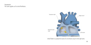 33
Treatment
The same applies as for atrial fibrillation.
Sinoatrial node
Atrioventricular
node
Right atrium
Left atrium
Atrial flutter is usually the result of a re-entrant circuit in the right atria.
 