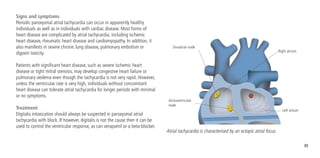 35
Signs and symptoms
Periodic paroxysmal atrial tachycardia can occur in apparently healthy
individuals as well as in individuals with cardiac disease. Most forms of
heart disease are complicated by atrial tachycardia, including ischemic
heart disease, rheumatic heart disease and cardiomyopathy. In addition, it
also manifests in severe chronic lung disease, pulmonary embolism or
digoxin toxicity.
Patients with significant heart disease, such as severe ischemic heart
disease or tight mitral stenosis, may develop congestive heart failure or
pulmonary oedema even though the tachycardia is not very rapid. However,
unless the ventricular rate is very high, individuals without concomitant
heart disease can tolerate atrial tachycardia for longer periods with minimal
or no symptoms.
Treatment
Digitalis intoxication should always be suspected in paroxysmal atrial
tachycardia with block. If however, digitalis is not the cause then it can be
used to control the ventricular response, as can verapamil or a beta-blocker.
Sinoatrial node
Atrioventricular
node
Right atrium
Left atrium
Atrial tachycardia is characterised by an ectopic atrial focus.
 