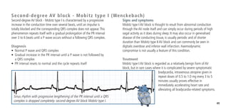 49
Signs and symptoms
Mobitz type I AV block is thought to result from abnormal conduction
through the AV node itself and can simply occur during periods of high
vagal activity as it does during sleep. It may also occur in generalised
disease of the conducting tissue, is usually periodic and of shorter
duration than Mobitz type II AV block and can commonly be seen in
digitalis overdose and inferior wall infarction. Haemodynamic
compromise is not usually a feature of this condition.
Treatment
Mobitz type I AV block is regarded as a relatively benign form of AV
block, but in rare cases where it is complicated by severe symptomatic
bradycardia, intravenous atropine given in
repeat doses of 0.5 to 1.0 mg every 3 to 5
minutes usually proves effective in
immediately accelerating heart rate and
alleviating all bradycardia-related symptoms.
Second-degree AV block - Mobitz type I is characterised by a progressive
increase in the conduction time over several beats, until an impulse is
totally blocked and the corresponding QRS complex does not appear.This
phenomenon repeats itself with a gradual prolongation of the PR interval
over 3 to 6 beats until a P wave occurs without a following QRS complex.
Diagnosis
•	 Normal P wave and QRS complex
•	 Gradual increase in the PR interval until a P wave is not followed by
a QRS complex
•	 PR interval resets to normal and the cycle repeats itself
Sinus rhythm with progressive lengthening of the PR interval until a QRS
complex is dropped completely: second-degree AV block Mobitz type I.
Second-degree AV block - Mobitz type I (Wenckebach)
 