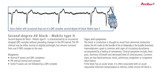 Signs and symptoms
The block in conduction is thought to result from abnormal conduction
below the AV node (in the bundle of His or bilaterally in the bundle branches).
Haemodynamic upset is common with signs of circulatory disturbance
accompanied by a feeling of remoteness. Clinical symptoms include chest
pain, shortness of breath and decreased level of consciousness. Common
signs are low blood pressure, shock, pulmonary congestion or congestive
heart failure.
If the block has an acute onset, it is often associated with an acute
myocardial infarction (anteroseptal or inferior), while chronic AV block is
Second-degree AV block - Mobitz type II
Second-degree AV block - Mobitz type II - is characterised by an occasional
dropped QRS complex without preceding changes in the PR interval.The PR
interval may be either normal or slightly prolonged, but remains constant
from one P-QRS complex to the next.
Diagnosis
•	 Normal P waves and QRS complexes
•	 PR interval normal and constant
•	 Some P waves are not followed by a QRS complex
Sinus rhythm with occasional drop-out of a QRS complex; second-degree AV block Mobitz type II.
 