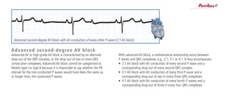 With advanced AV block, a mathematical relationship exists between
P waves and QRS complexes, e.g., 2:1, 3:1 or 4:1. It thus encompasses:
•	 2:1 AV block with AV conduction of every second P wave and a
corresponding drop-out of every second QRS complex
•	 3:1 AV block with AV conduction of every third P wave and a
corresponding drop-out of two in every three QRS complexes
•	 4:1 AV block with AV conduction of every fourth P waves and a
corresponding drop-out of three in every four QRS complexes
Advanced second-degree AV block
Advanced AV or high-grade AV block is characterised by an alternate
drop-out of the QRS complex, or the drop-out of two or more QRS
consecutive complexes.Advanced AV block cannot be categorised as
Mobitz type I or type II because it is impossible to say whether the PR
interval for the non-conducted P waves would have been the same as,
or longer than, the conducted P waves.
Advanced second-degree AV block with AV conduction of every other P wave (2:1 AV block).
 