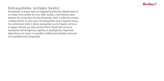 Extrasystoles (ectopic beats)
Extrasystoles or ectopic beats are triggered by premature depolarisation of
an ectopic focus outside the sinus node. Usually, a fixed distance exists
between the normal beat and the extrasystole, which is called the constant
coupling interval. In some cases, the extrasystoles occur irregularly among
the normal beats while in others, extrasystoles can be frequent and occur
at regular intervals, e.g. every second, third or fourth beat can be an
extrasystole termed bigeminy, trigeminy or quadrigeminy, respectively.
Depending on its origin, it is possible to differentiate between ventricular
and supraventricular extrasystoles.
 