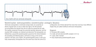 configuration, but if those derived from more than one focus have different
shapes they are called multifocal ventricular extrasystoles.
Diagnosis
•	 Premature QRS complex
•	 A wide, tall and abnormal QRS complex (>0.12 s)
•	 T wave, often inverted
•	 Fully compensatory postextrasystolic pause
Ventricular extrasystoles or ventricular ectopic beats are caused by an
electric impulse from an area in either the right or the left ventricle
occurring before the impulse from the SA node has passed the AV node.
The impulse conduction through the ventricles becomes abnormal, and the
resultant QRS complexes are widened and abnormal.The extrasystoles are
followed by a pause (the postextrasystolic pause) but the interval between
the preceding and following beat is still twice as long as the normal
interval in the basic sinus rhythm.The postextrasystolic pause is said to be
fully compensatory. Extrasystoles from the same focus have the same ECG
Sinus rhythm with one ventricular extrasystole.
Ventricular extrasystoles (ventricular ectopic beats)
 