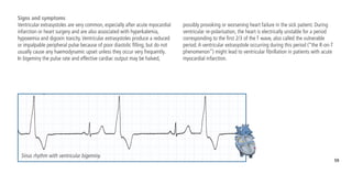 59
Signs and symptoms
Ventricular extrasystoles are very common, especially after acute myocardial
infarction or heart surgery and are also associated with hyperkalemia,
hypoxemia and digoxin toxicity.Ventricular extrasystoles produce a reduced
or impalpable peripheral pulse because of poor diastolic filling, but do not
usually cause any haemodynamic upset unless they occur very frequently.
In bigeminy the pulse rate and effective cardiac output may be halved,
possibly provoking or worsening heart failure in the sick patient. During
ventricular re-polarisation, the heart is electrically unstable for a period
corresponding to the first 2/3 of the T wave, also called the vulnerable
period.A ventricular extrasystole occurring during this period (“the R-on-T
phenomenon”) might lead to ventricular fibrillation in patients with acute
myocardial infarction.
Sinus rhythm with ventricular bigeminy.
 
